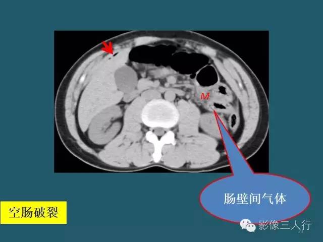 【PPT】肠管与肠系膜损伤的CT诊断