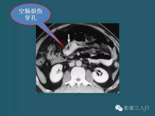 【PPT】肠管与肠系膜损伤的CT诊断