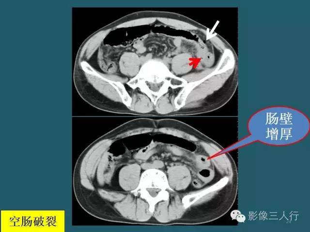 【PPT】肠管与肠系膜损伤的CT诊断