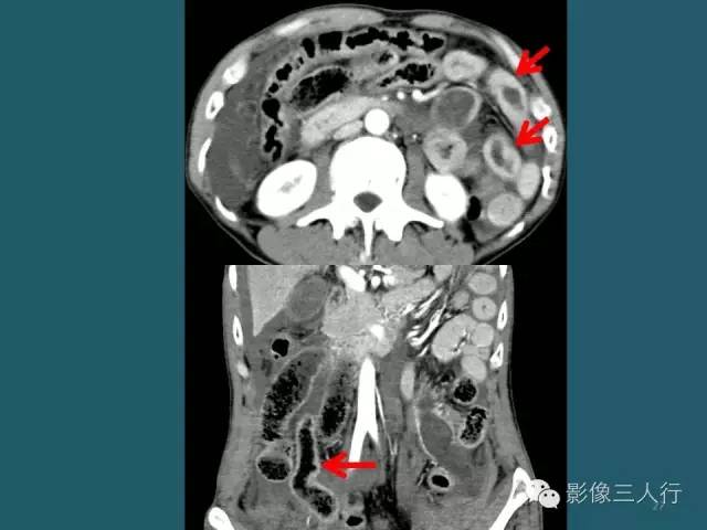 【PPT】肠管与肠系膜损伤的CT诊断