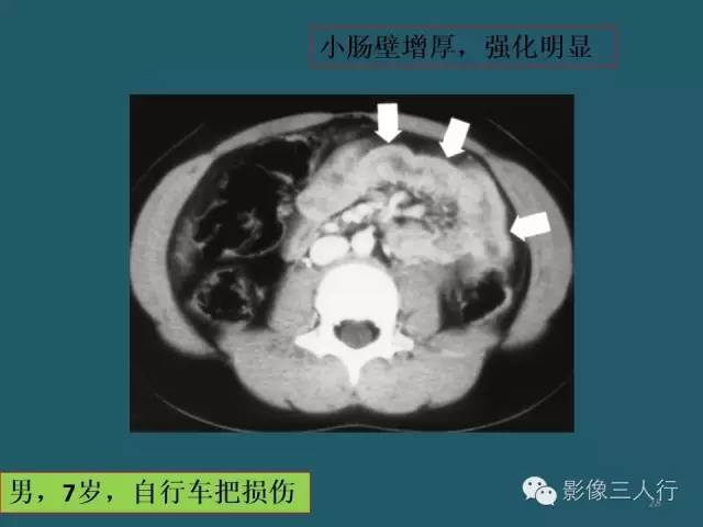 【PPT】肠管与肠系膜损伤的CT诊断
