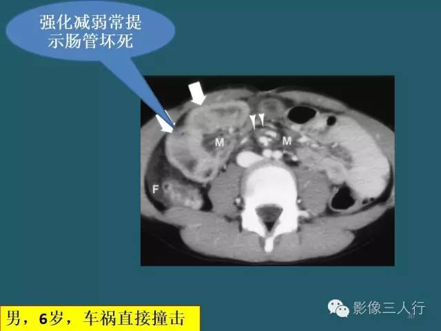 【PPT】肠管与肠系膜损伤的CT诊断