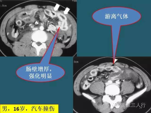 【PPT】肠管与肠系膜损伤的CT诊断