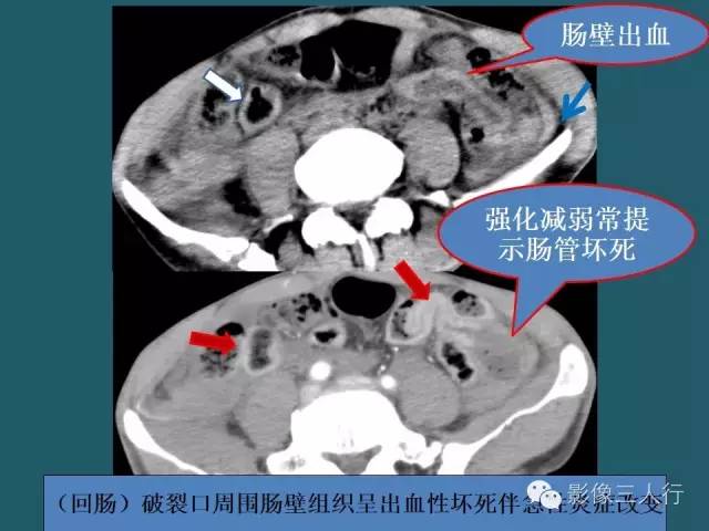 【PPT】肠管与肠系膜损伤的CT诊断