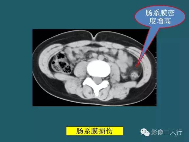 【PPT】肠管与肠系膜损伤的CT诊断
