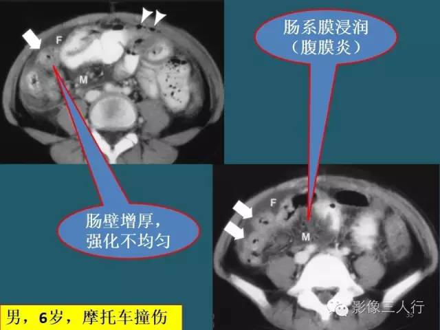 【PPT】肠管与肠系膜损伤的CT诊断