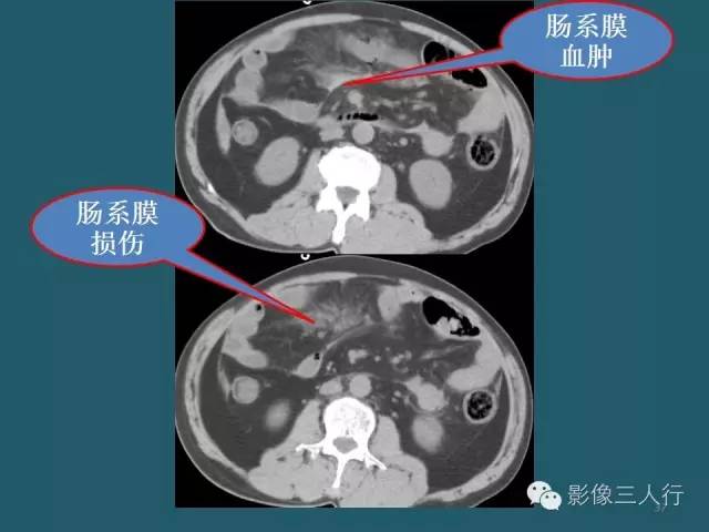 【PPT】肠管与肠系膜损伤的CT诊断