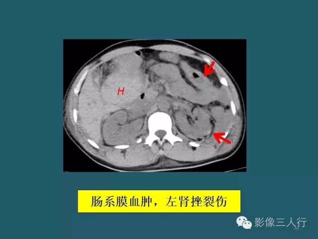 【PPT】肠管与肠系膜损伤的CT诊断