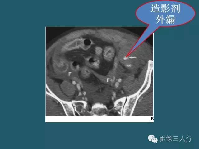 【PPT】肠管与肠系膜损伤的CT诊断