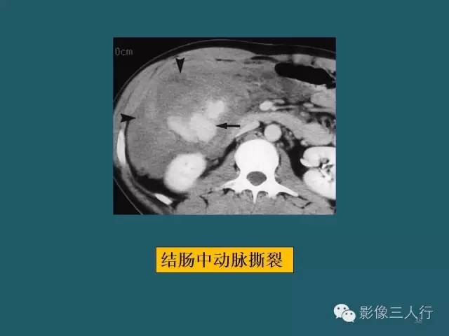【PPT】肠管与肠系膜损伤的CT诊断