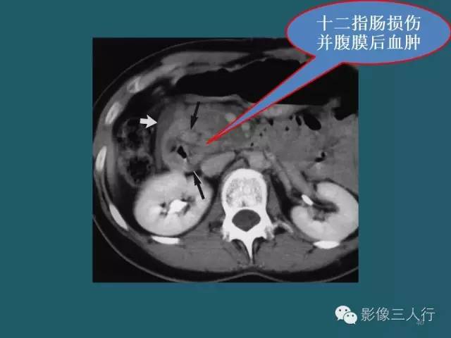 【PPT】肠管与肠系膜损伤的CT诊断