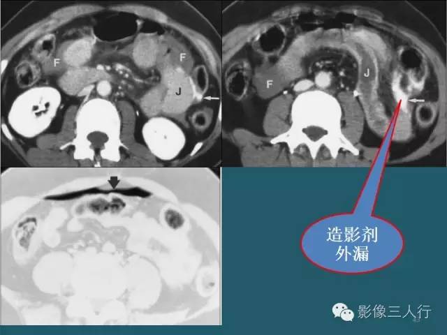 【PPT】肠管与肠系膜损伤的CT诊断