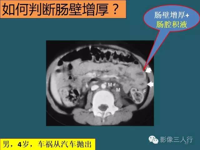 【PPT】肠管与肠系膜损伤的CT诊断