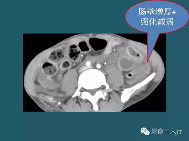 【PPT】肠管与肠系膜损伤的CT诊断