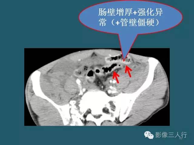 【PPT】肠管与肠系膜损伤的CT诊断