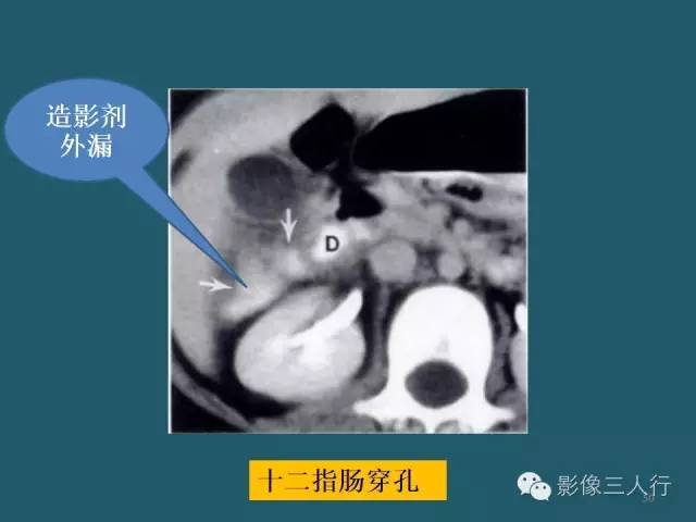 【PPT】肠管与肠系膜损伤的CT诊断