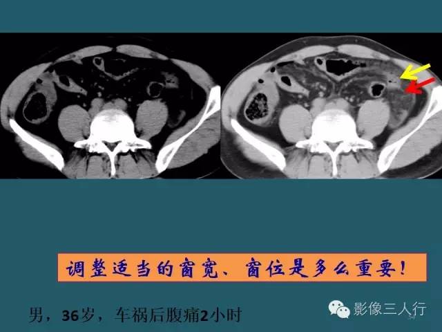 【PPT】肠管与肠系膜损伤的CT诊断