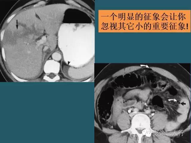 【PPT】肠管与肠系膜损伤的CT诊断