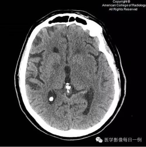 【病例】血管周围间隙扩大1例CT及MR影像表现