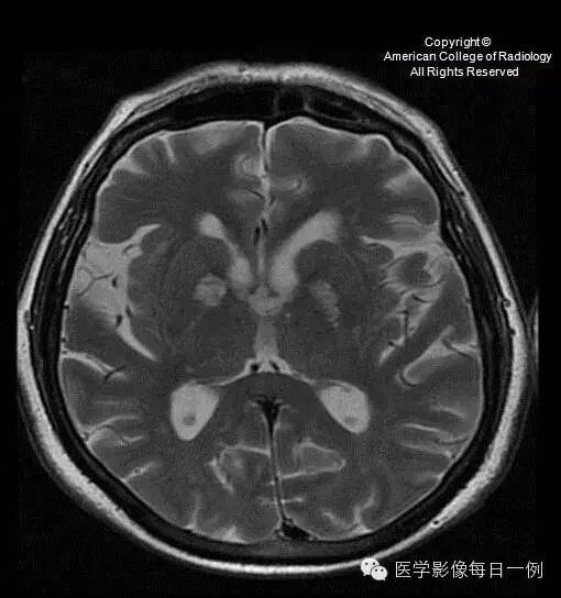 【病例】血管周围间隙扩大1例CT及MR影像表现