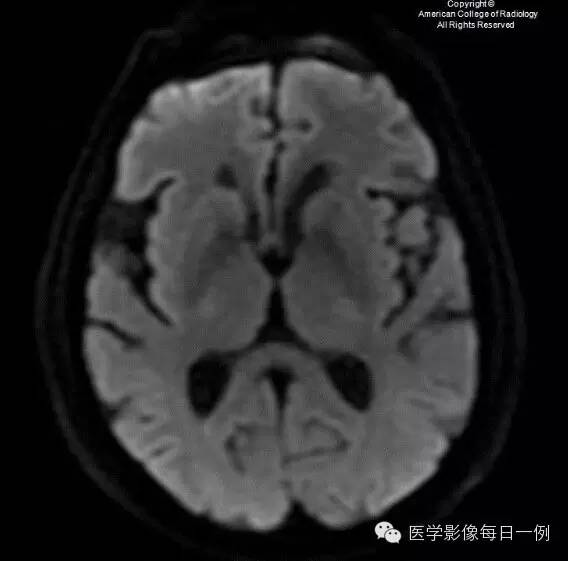 【病例】血管周围间隙扩大1例CT及MR影像表现