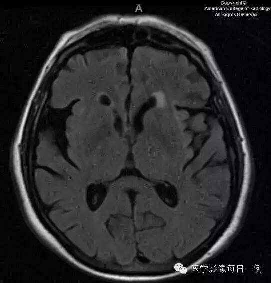 【病例】血管周围间隙扩大1例CT及MR影像表现