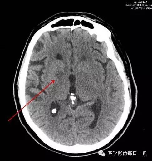 【病例】血管周围间隙扩大1例CT及MR影像表现