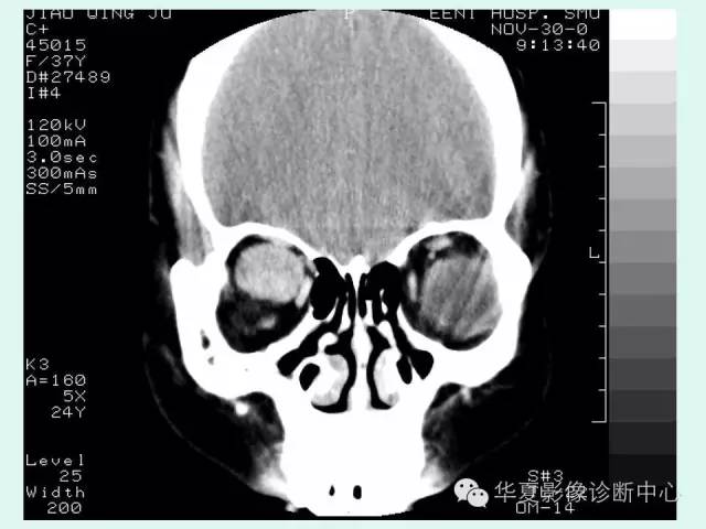 【病例】视神经脑膜瘤1例CT影像表现