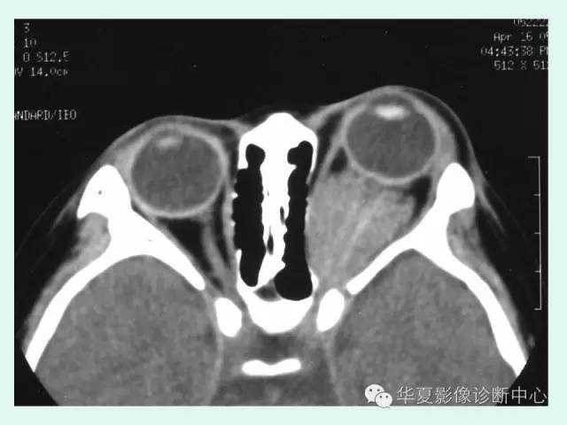 【病例】视神经脑膜瘤1例CT影像表现