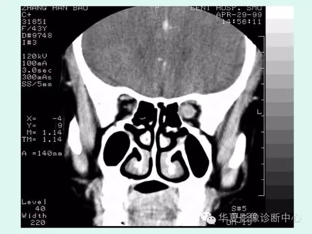 【病例】视神经脑膜瘤1例CT影像表现
