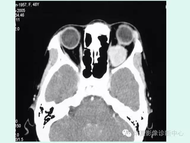 【病例】视神经脑膜瘤1例CT影像表现