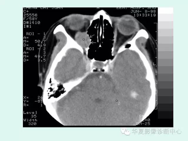 【病例】眼眶神经鞘膜瘤一例CT影像表现