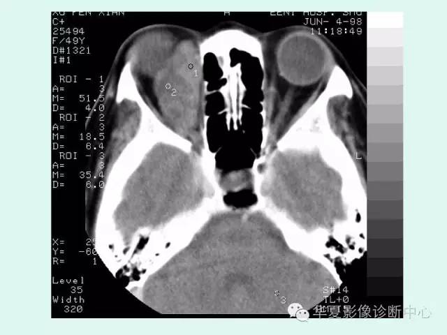 【病例】眼眶神经鞘膜瘤一例CT影像表现