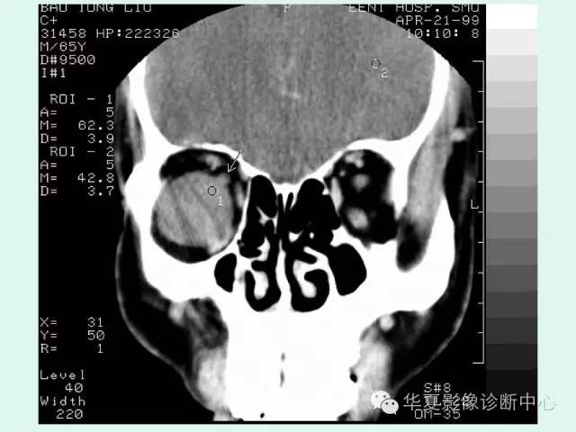 【病例】眼眶神经鞘膜瘤一例CT影像表现