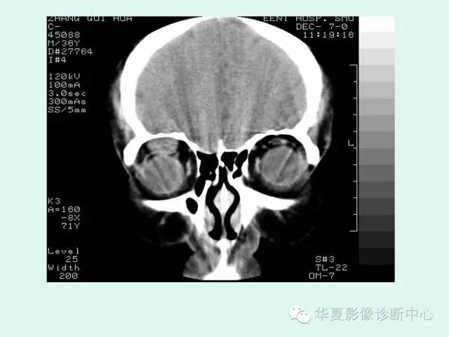 【病例】眼眶神经鞘膜瘤一例CT影像表现
