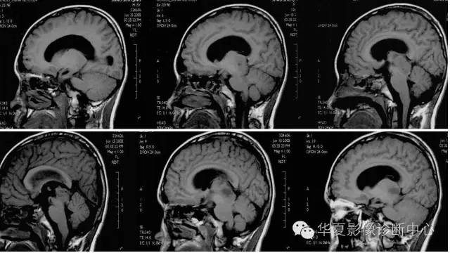 【病例】松果体区生殖细胞瘤1例CT及MR影像表现