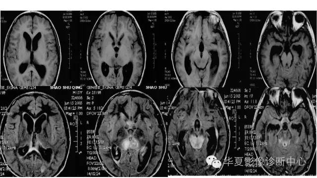 【病例】松果体区生殖细胞瘤1例CT及MR影像表现