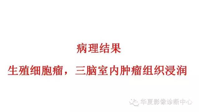 【病例】松果体区生殖细胞瘤1例CT及MR影像表现