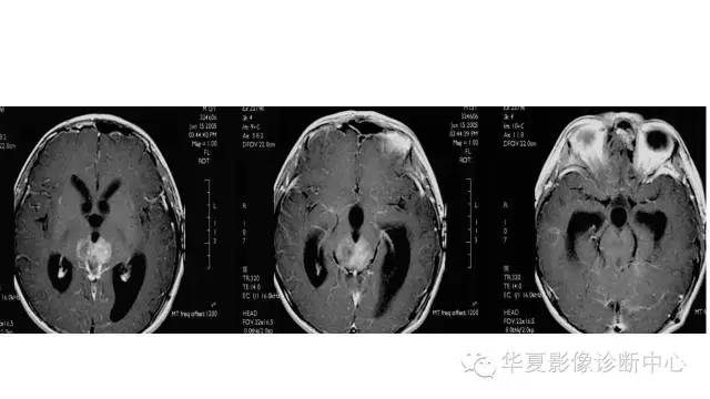 【病例】松果体区生殖细胞瘤1例CT及MR影像表现