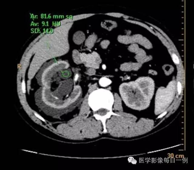 【病例】肾淋巴管瘤1例CT影像表现