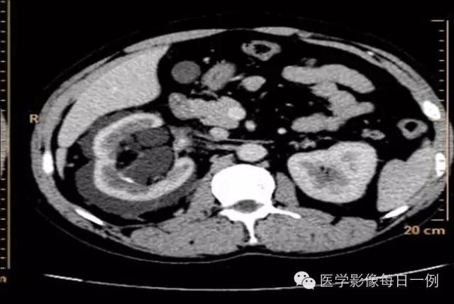 【病例】肾淋巴管瘤1例CT影像表现 【病例】肾淋巴管瘤1例CT影像表现