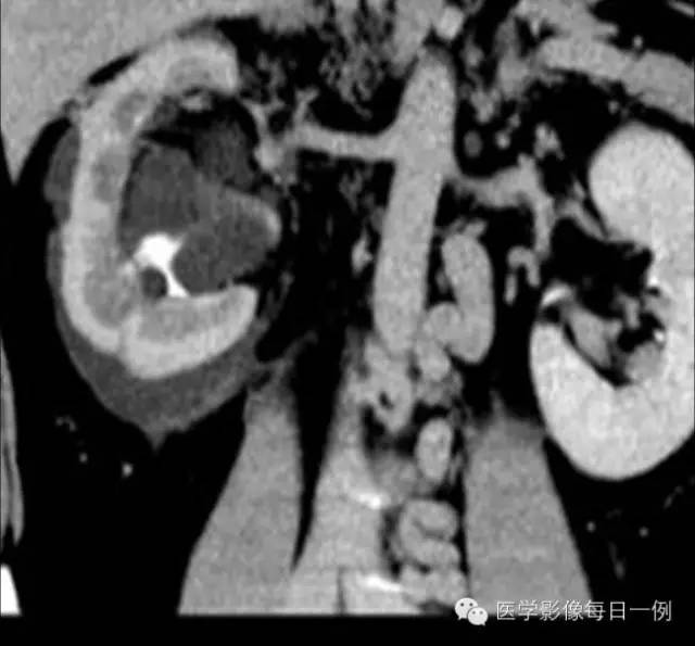 【病例】肾淋巴管瘤1例CT影像表现 【病例】肾淋巴管瘤1例CT影像表现