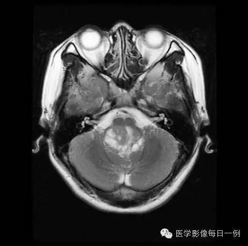 【病例】四脑室室管膜瘤1例MR影像表现