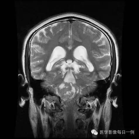 【病例】四脑室室管膜瘤1例MR影像表现
