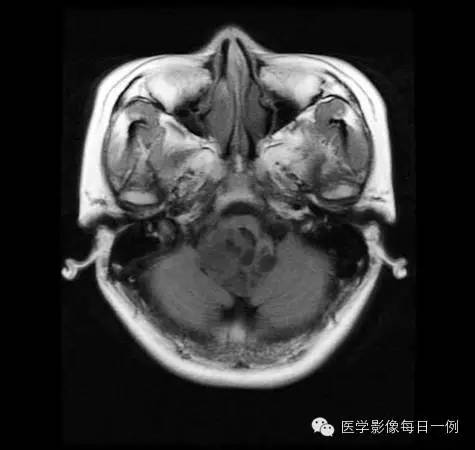 【病例】四脑室室管膜瘤1例MR影像表现