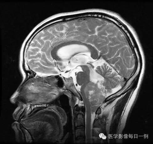 【病例】四脑室室管膜瘤1例MR影像表现