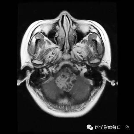 【病例】四脑室室管膜瘤1例MR影像表现