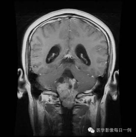 【病例】四脑室室管膜瘤1例MR影像表现
