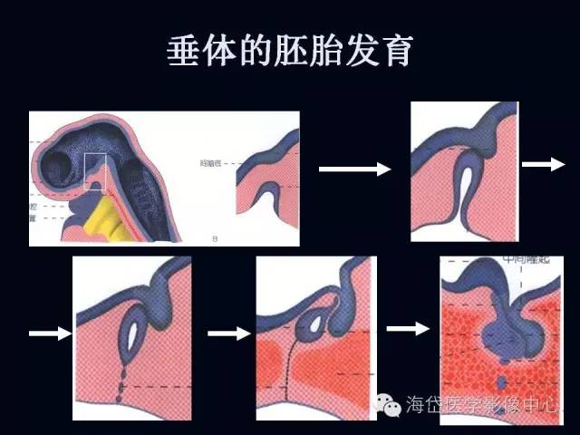 垂体柄阻断综合症MR表现