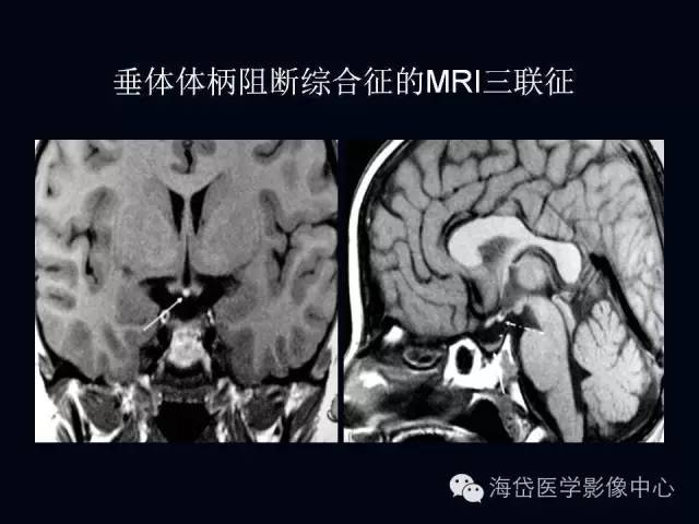 垂体柄阻断综合症MR表现